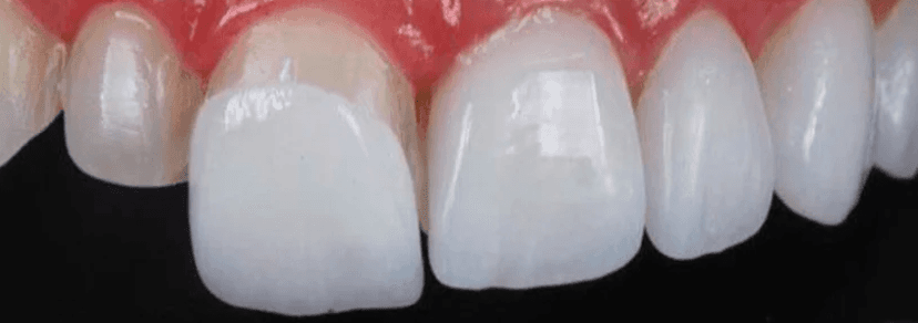 Paciente feliz após tratamento de Facetas de Porcelana no bairro Barra